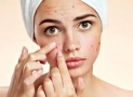 How To Get Rid of Acne ?