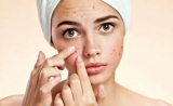 How To Get Rid of Acne ?