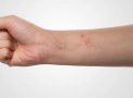 What is eczema ?