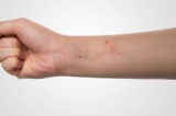 What is eczema ?