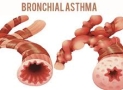 What is bronchial asthma?