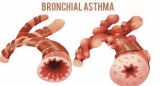 What is bronchial asthma?