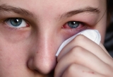 What is conjunctivitis and Treatment ?