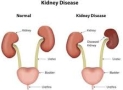 How to Save Yourself From  Kidney Disease ?