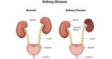 How to Save Yourself From  Kidney Disease ?