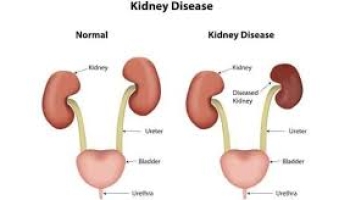 How to Save Yourself From  Kidney Disease ?