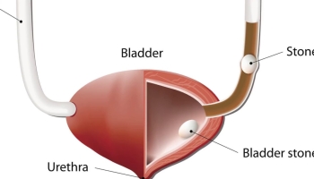 How are  Urinary Stones diagnosed  ?