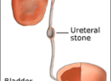 Urinary Stones -Symptoms and treatment