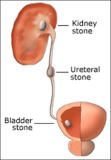 Urinary Stones -Symptoms and treatment