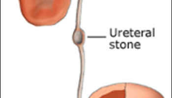 Urinary Stones -Symptoms and treatment