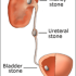 How are  Urinary Stones diagnosed  ?